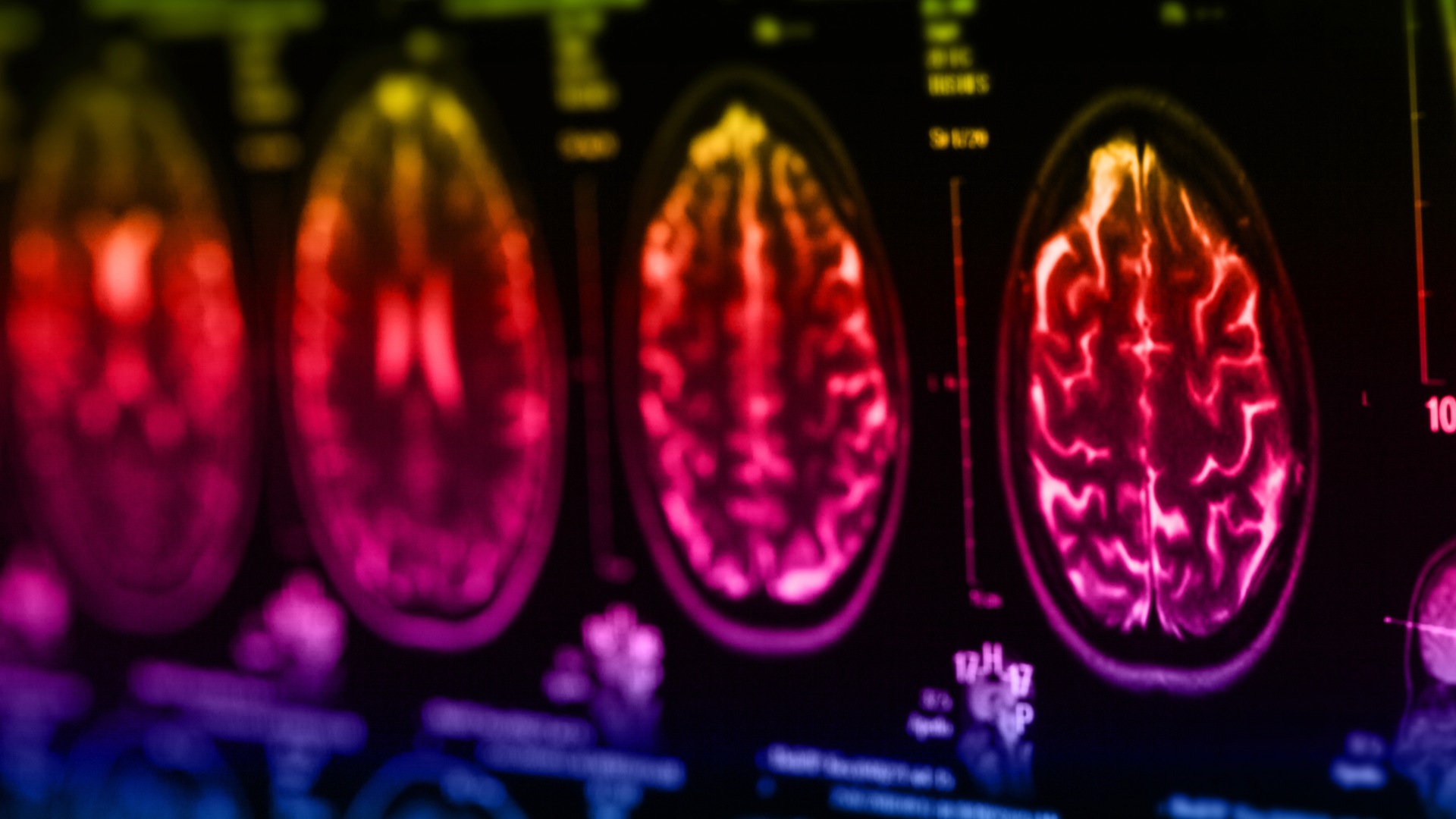 Brain Tumors – Still an Area of Significant Unmet Need