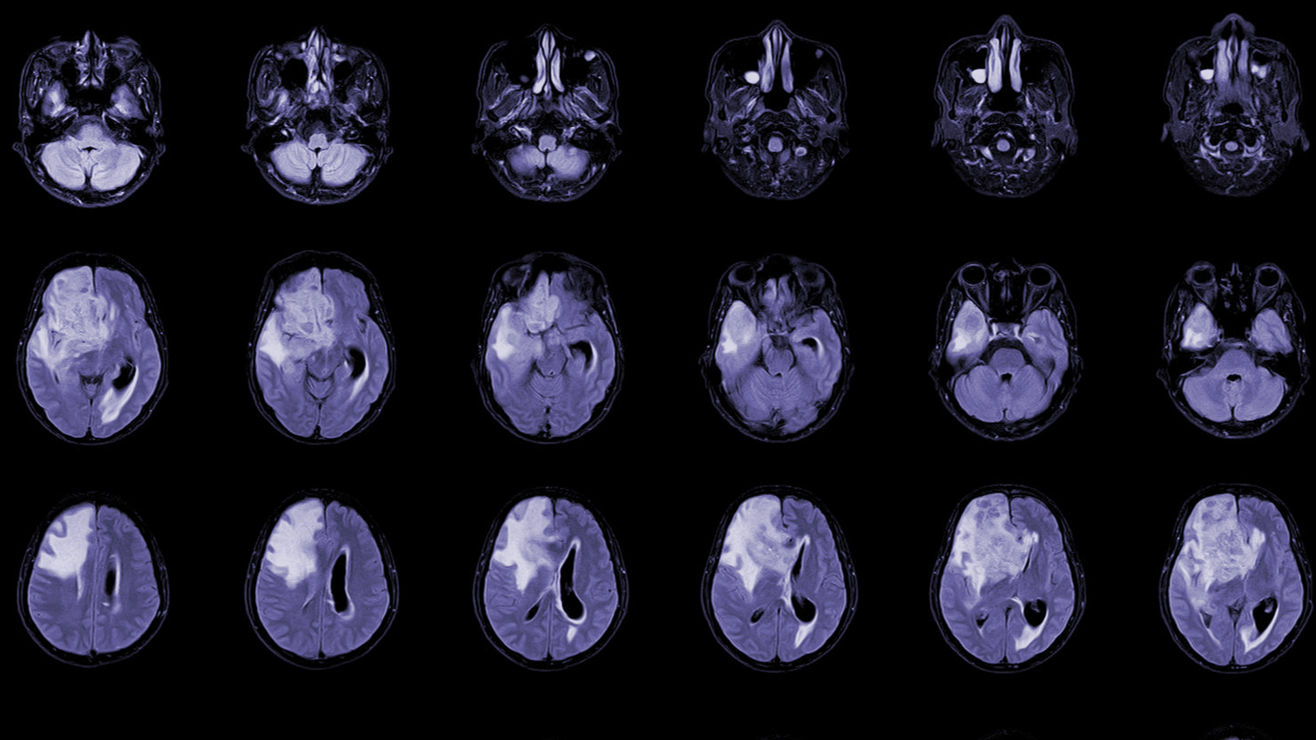 Glioblastoma Clinical Trials – Where Progress is Actually Happening in Glioma Research