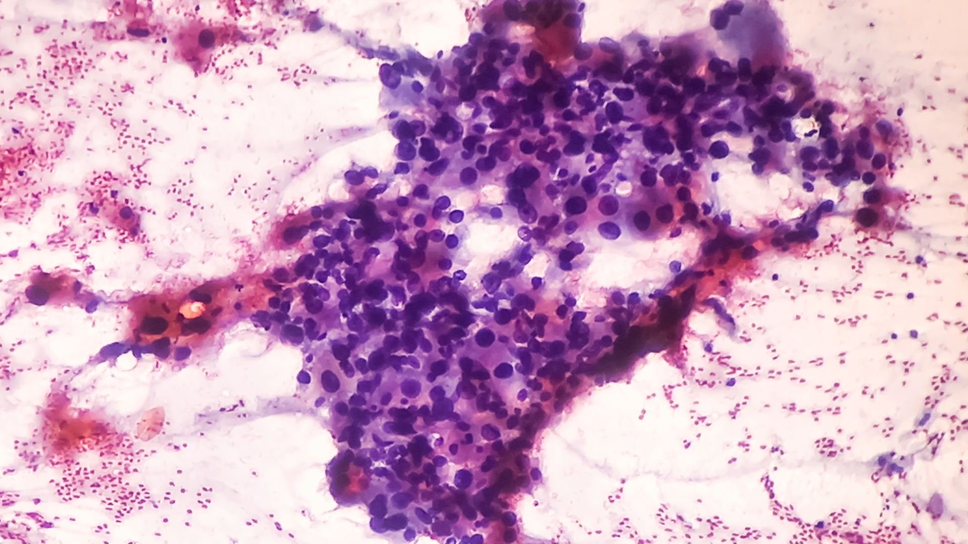 Sarcoma Clinical Trials – Cell Therapy’s Solid-Tumor Breakthrough, and What It Means for a Rare Cancer